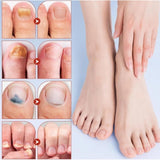 Fungal Nail Patches (Yellow)