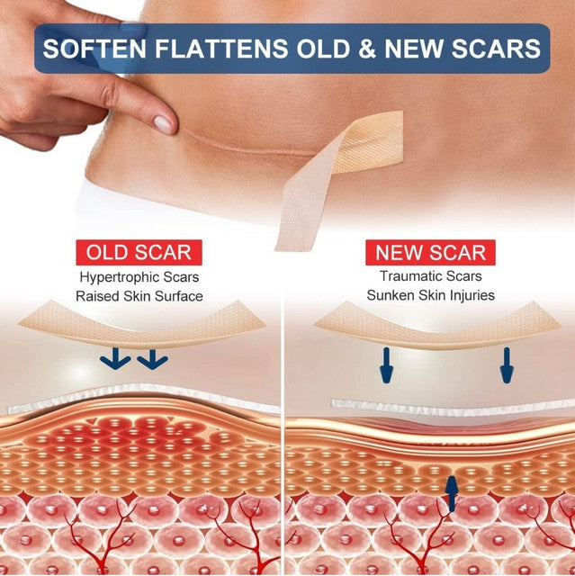 Silicone Scar Tape (Beige)